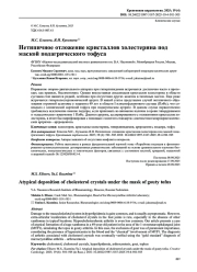 Нетипичное отложение кристаллов холестерина под маской подагрического тофуса